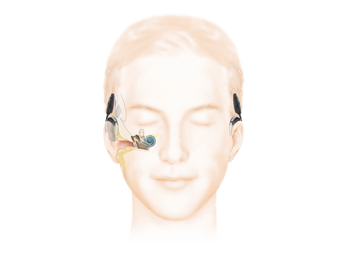 A diagram showing how a cochlear implant is inserted